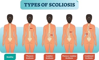 Is Bouncing On Rebounder Bad For Scoliosis