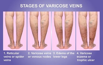 Is Trampolining Bad For Varicose Veins